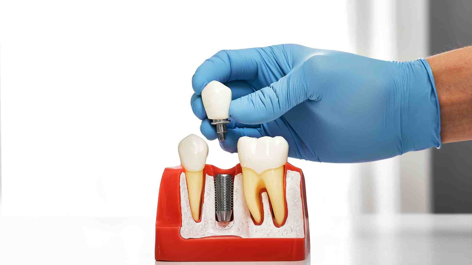 Who Is a Good Candidate for Dental Implants?