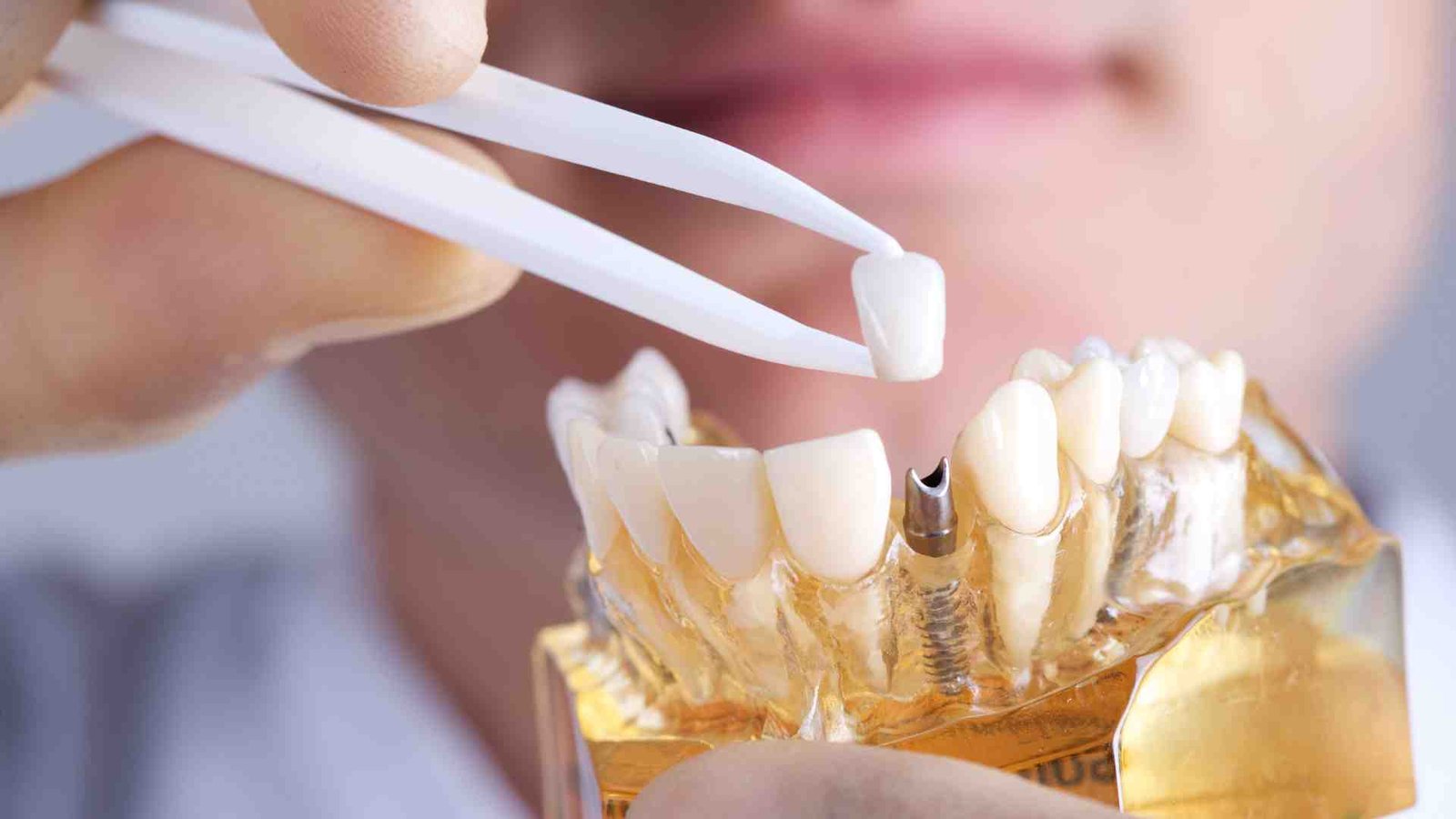 The Process of Getting Dental Implants in Dubai