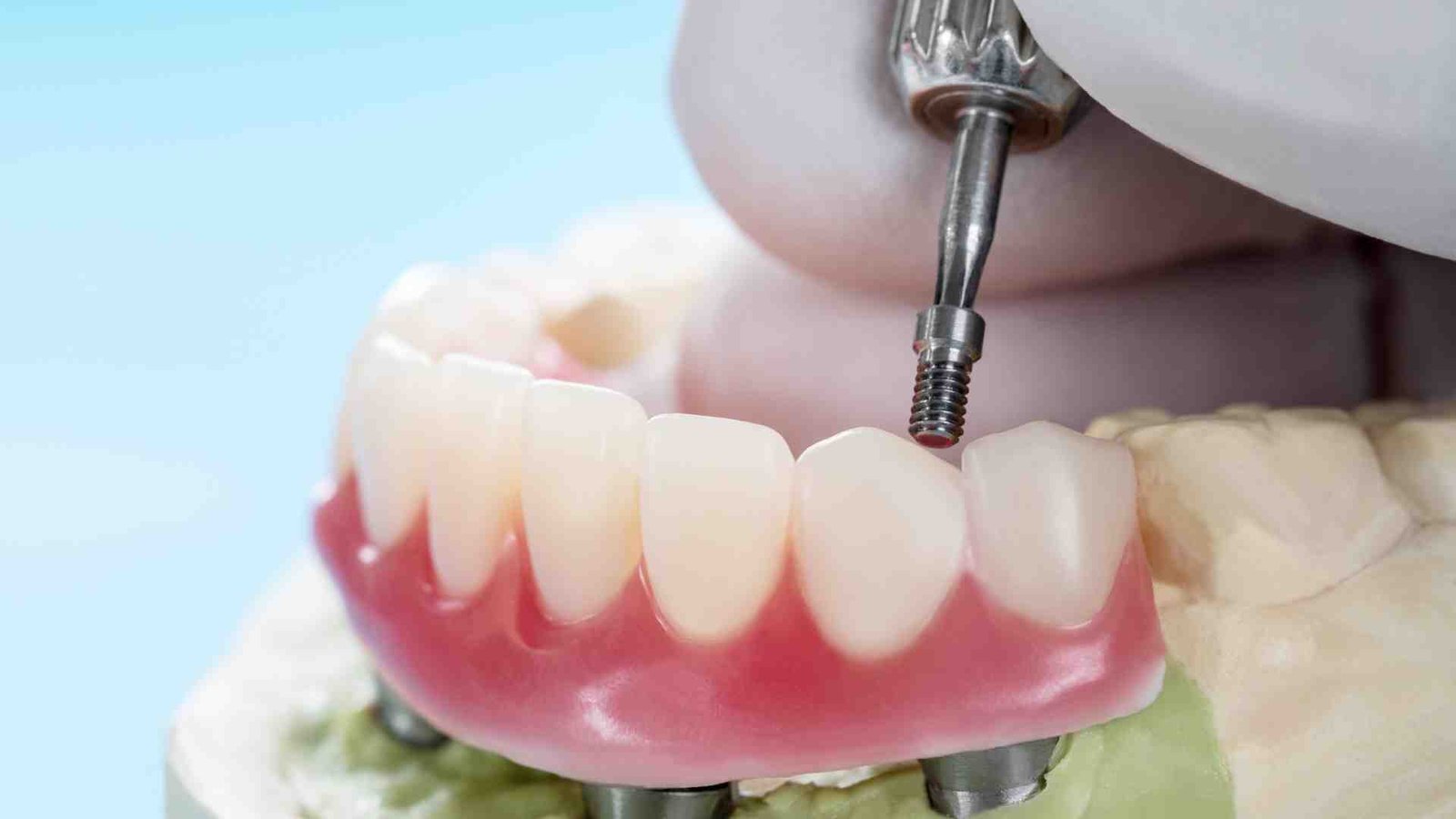 The Dental Implant Procedure – What to Expect